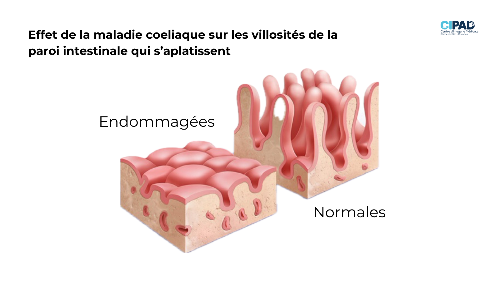 🌾 La Maladie Cœliaque 🌾 - CIPAD